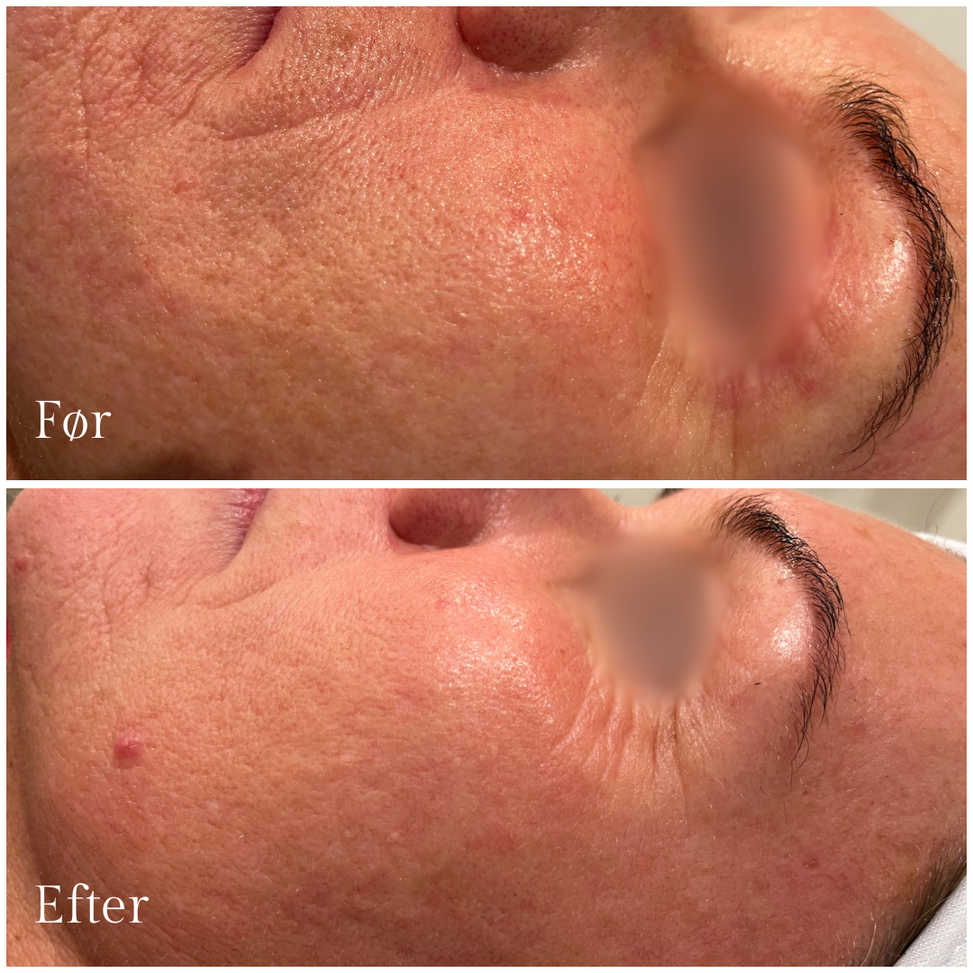 galleri_skinpen_mikroneedling_1