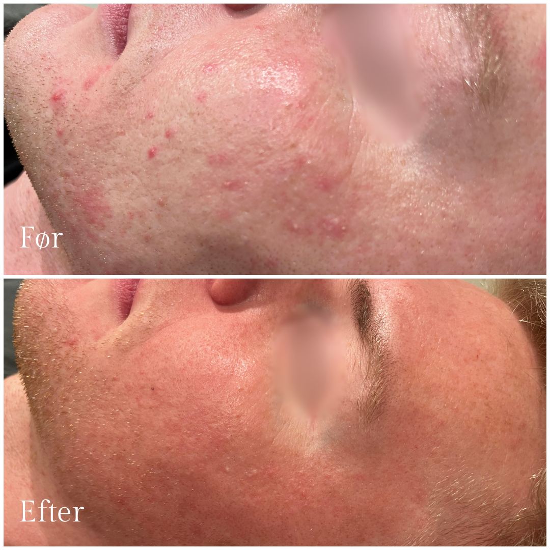galleri_skinpen_mikroneedling_2