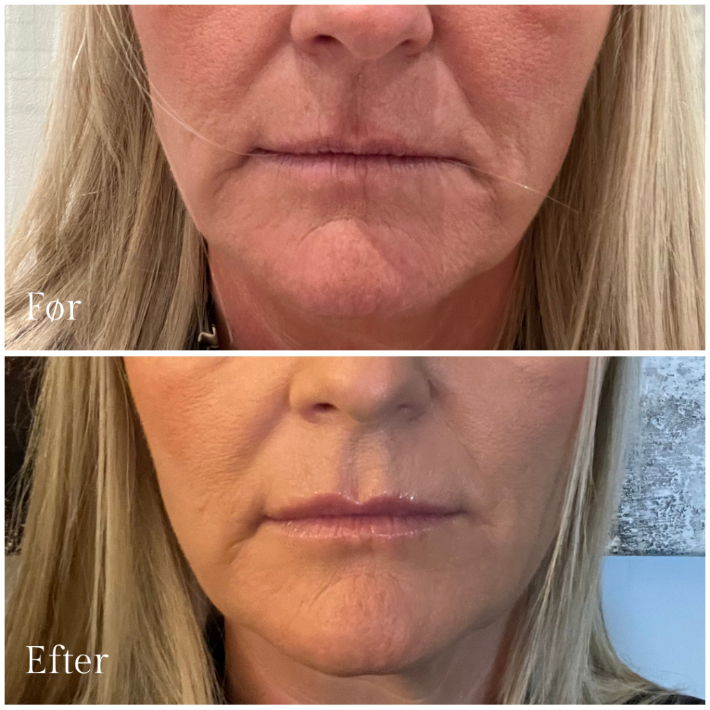 Botox_lipflip