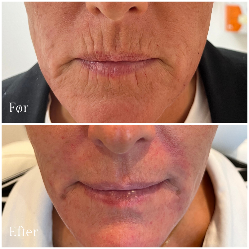 Botox_overlæbe