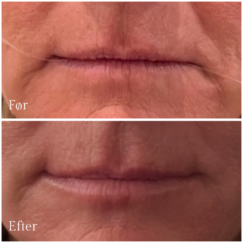 Botox_mundvige